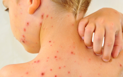 Chickenpox in kids – help is at hand