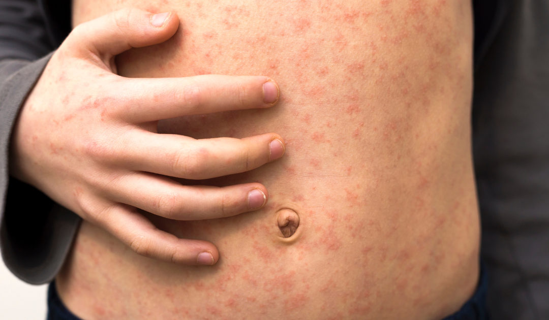 The Measles Warning Signs You Should Know About | ZoomDoc